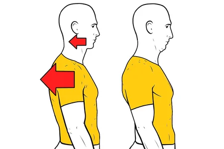 Doble barbilla con retraccion escapular