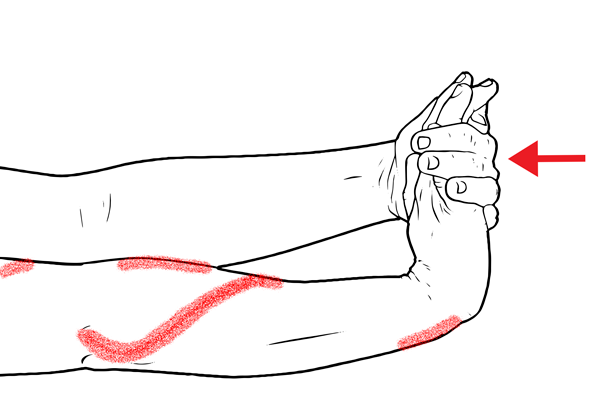 Tendinopatia del biceps.